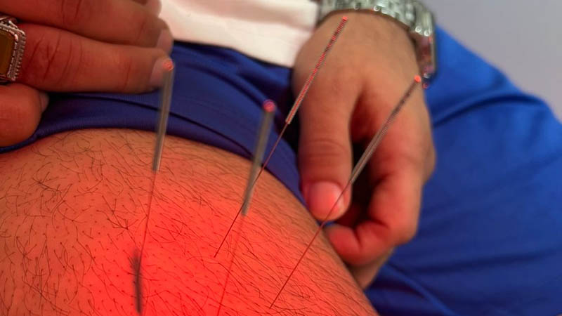 درای نیدلینگ (DRY Needling)